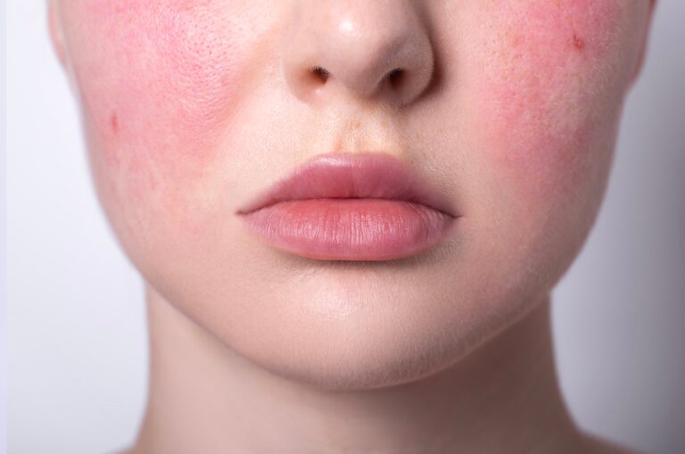 Redness, Rosacea & Broken Capillaries