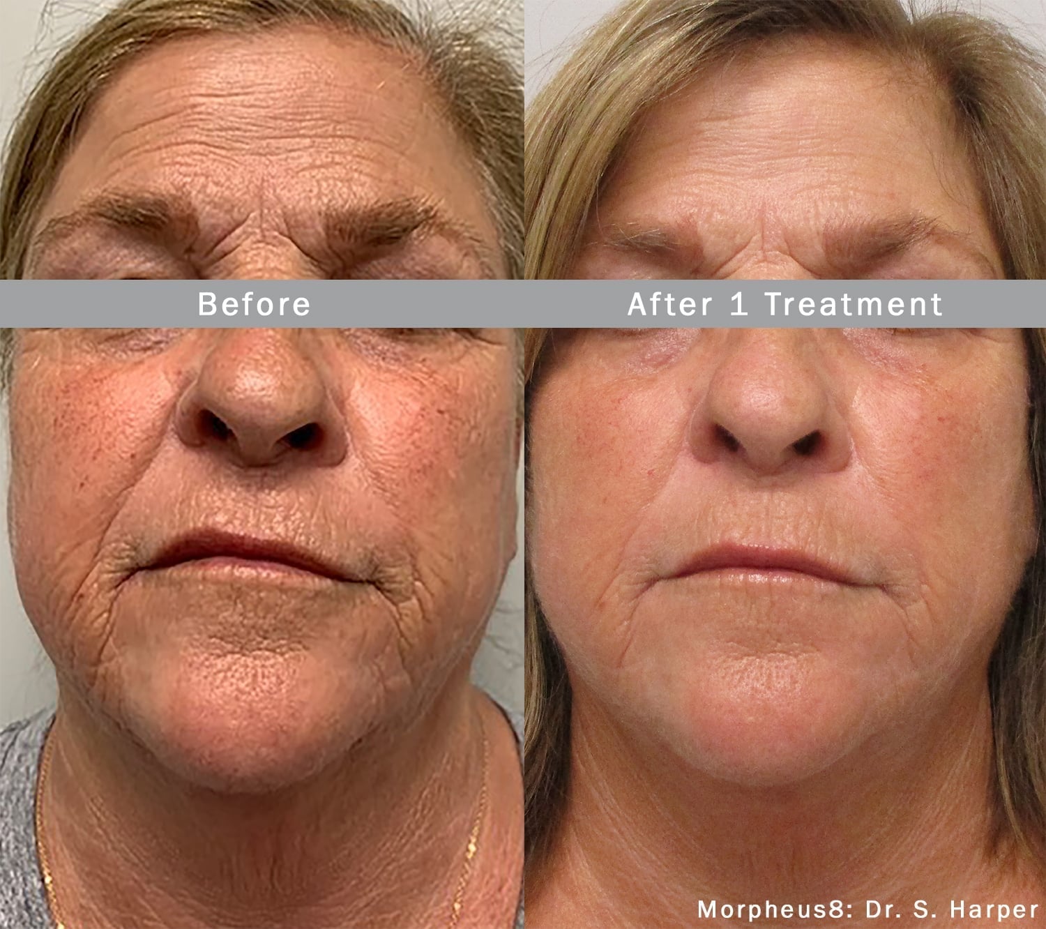 Morpheus8 treatment results