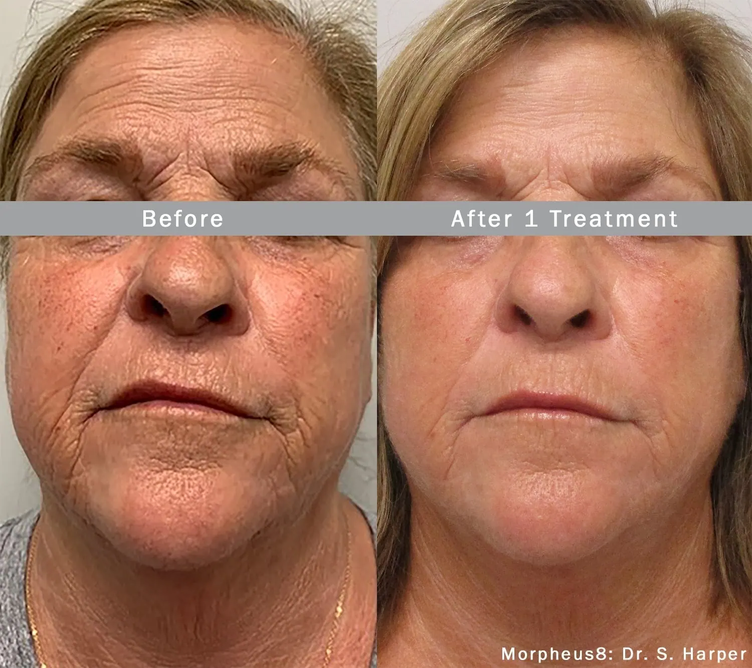 Morpheus8 treatment results